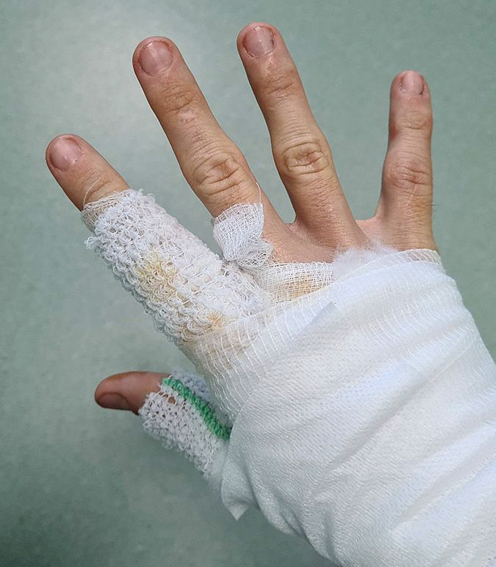 Romain Grosjean posts a picture of his injured right hand to social media.